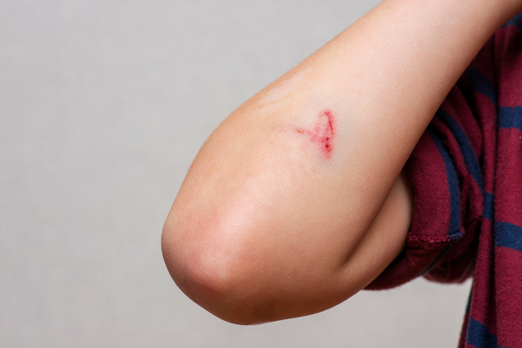 Close up picture of a gash on someone's elbow